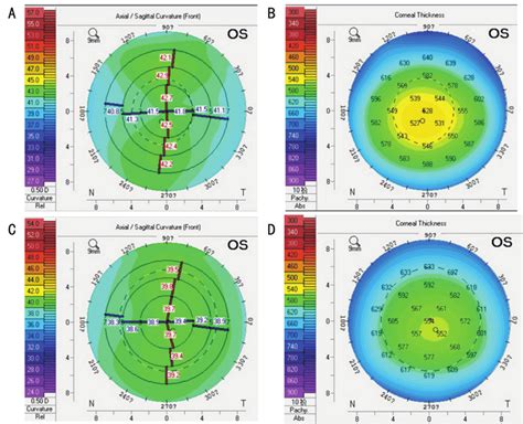 instrument used to measure corneal thickness|corneal thickness chart.